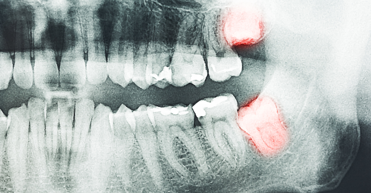 Dental XRays Why You Need Them and Why They’re Safe